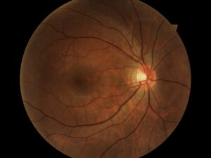 fundus picture retinal picture